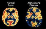 MRI-Scan-Alzheimers-Disease